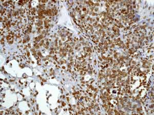 ab52988 showing positive staining in Ovarian carcinoma tissue.