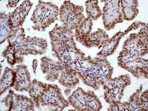 ab52988 showing positive staining in Thyroid gland carcinoma tissue.