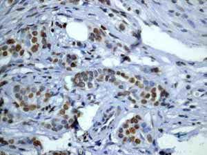 ab52988 showing positive staining in Breast carcinoma tissue.
