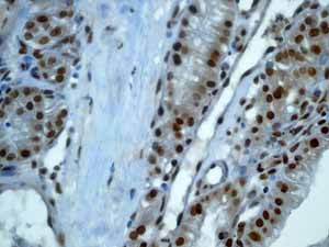 ab52988 showing positive staining in Colonic adenocarcinoma tissue.