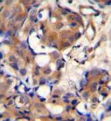 Immunohistochemical analysis of formalin-fixed, paraffin-embedded Human breast carcinoma tissue labeling Kininogen 1 with ab170475 at 1/50 dilution, followed by peroxidase-conjugated secondary antibody and DAB staining.