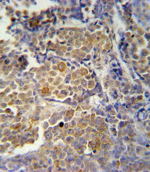 Immunohistochemical analysis of formalin fixed, paraffin embedded Human skin carcinoma tissue labeling KIR2DS2 with ab175486 at 1/10 dilution, followed by peroxidase conjugation of the secondary antibody and DAB staining.
