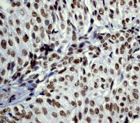 ab40886 staining human bladder carcinoma for Histone H2B expression (1:250 dilution)ab40886 staining human bladder carcinoma for Histone H2B expression (1:250 dilution)