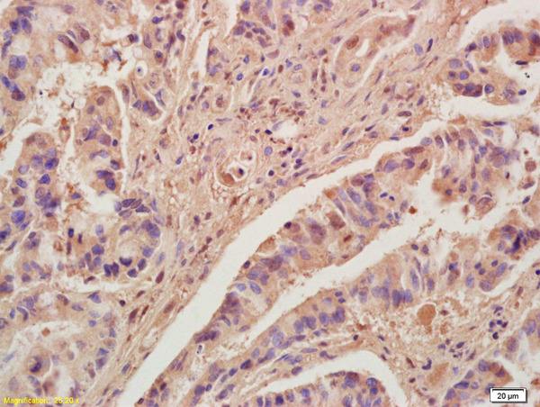 Immunohistochemical analysis of formalin-fixed paraffin-embedded Human colon carcinoma tissue labeling KLF2 with ab203591 at 1/200 dilution, followed by conjugation to the secondary antibody and DAB staining.