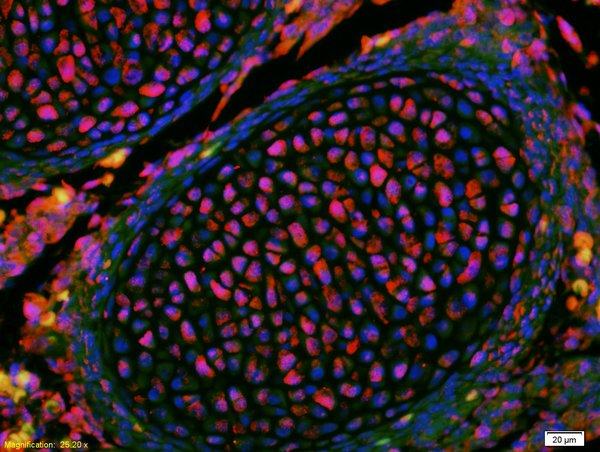 Immunohistochemical analysis of formalin-fixed paraffin-embedded Human colon carcinoma tissue labeling KLF2 with ab203591 at 1/200 dilution, followed by Goat Anti-Rabbit IgG (Cy3 conjugated) at 1/200 dilution.