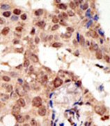 Formalin-fixed and paraffin-embedded human breast carcinoma tissue reacted with the primary antibody, which was peroxidase-conjugated to the secondary antibody, followed by AEC staining. This data demonstrates the use of this antibody for immunohistochemistry; clinical relevance has not been evaluated.