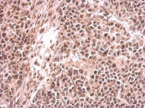 Immunohistochemical analysis of paraffin-embedded HeLa xenograft tissue, labeling KMT1C / G9a using ab183889 at a 1/500 dilution.