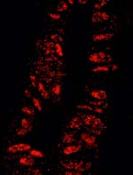 Detection of Human KPNA3.Sample: FFPE section of Human colon carcinoma.Antibody: ab84706 used at a dilution of 1/100.Detection: Red-fluorescent goat anti-rabbit IgG highly cross-adsorbed Antibody Hilyte PlusTM 555 used at a dilution of 1/100.