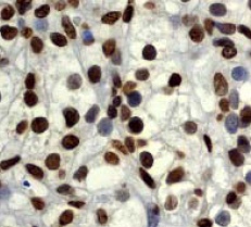 Ab45695 (1:100) staining human Histone H2B in human kidney carcinoma by immunohistochemistry using paraffin embedded tissue.Ab45695 (1:100) staining human Histone H2B in human kidney carcinoma by immunohistochemistry using paraffin embedded tissue.