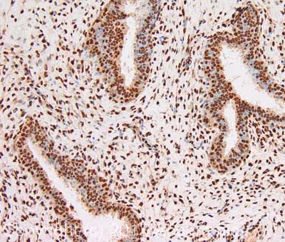 IHC image of Histone H2B staining in human breast fibroadenoma formalin fixed paraffin embedded tissue section, performed on a Leica BondTM system using the standard protocol B. The section was pre-treated using heat mediated antigen retrieval with sodium citrate buffer (pH6, epitope retrieval solution 1) for 20 mins. The section was then incubated with ab134211, 1µg/ml, for 15 mins at room temperature. A goat anti-chicken biotinylated secondary antibody was used to detect the primary, and visualized using an HRP conjugated ABC system. DAB was used as the chromogen. The section was then counterstained with haematoxylin and mounted with DPX. For other IHC staining systems (automated and non-automated) customers should optimize variable parameters such as antigen retrieval conditions, primary antibody concentration and antibody incubation times.