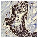 ab52985, at a 1/100 dilution, staining Human Histone H2B in breast carcinoma using Immunohistochemistry, Paraffin Embedded tissue.ab52985, at a 1/100 dilution, staining Human Histone H2B in breast carcinoma using Immunohistochemistry, Paraffin Embedded tissue.