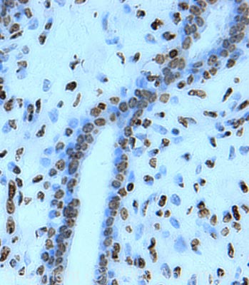 IHC image of Histone H2B staining in human breast carcinoma FFPE section, performed on a BondTM system using the standard protocol F. The section was pre-treated using heat mediated antigen retrieval with sodium citrate buffer (pH6, epitope retrieval solution 1) for 20 mins. The section was then incubated with ab52484, 1µg/ml, for 15 mins at room temperature and detected using an HRP conjugated compact polymer system. DAB was used as the chromogen. The section was then counterstained with haematoxylin and mounted with DPX.