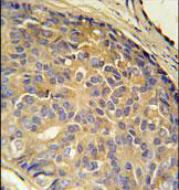 Immunohistochemistry analysis of formalin-fixed paraffin-embedded Human prostate carcinoma labeling L12R1 with ab175601 at 1/10 followed by peroxidase conjugation of the secondary antibody and DAB staining.