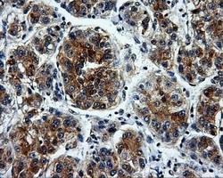 ab114019 at 1/50 dilution staining L1CAM in Human liver carcinoma tissue by immunohistochemistry (FFPE).