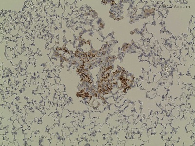 ab3200 staining L1CAM in human cancer cells in mouse lung tissue sections by Immunohistochemistry (IHC-P - paraformaldehyde-fixed, paraffin-embedded sections). Tissue was fixed with formaldehyde and blocked with 1% BSA for 1 hour at 25°C; antigen retrieval was by heat mediation in a citrate buffer, pH 6. Samples were incubated with primary antibody (1/100 in PBS + 1% BSA) for 2 hours at 25°C. A Biotin-conjugated goat anti-mouse IgG polyclonal (1/1000) was used as the secondary antibody.See Abreview