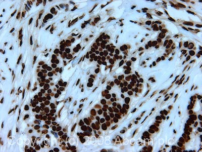 IHC image of Histone H2B staining in human breast carcinoma FFPE section, performed on a BondTM system using the standard protocol F. The section was pre-treated using heat mediated antigen retrieval with sodium citrate buffer (pH6, epitope retrieval solution 1) for 20 mins. The section was then incubated with ab1790, 1µg/ml, for 8 mins at room temperature and detected using an HRP conjugated compact polymer system. DAB was used as the chromogen. The section was then counterstained with haematoxylin and mounted with DPX.