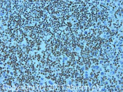 IHC image of ab32535 staining in human breast cancer formalin fixed paraffin embedded tissue section, performed on a Leica BondTM system using the standard protocol F. The section was pre-treated using heat mediated antigen retrieval with sodium citrate buffer (pH6, epitope retrieval solution 1) for 20 mins. The section was then incubated with ab32535, 5µg/ml, for 15 mins at room temperature and detected using an HRP conjugated compact polymer system. DAB was used as the chromogen. The section was then counterstained with haematoxylin and mounted with DPX.For other IHC staining systems (automated and non-automated) customers should optimize variable parameters such as antigen retrieval conditions, primary antibody concentration and antibody incubation times.