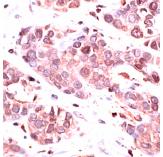 ab74393, at 1/25 dilution, staining Lamin B1 in formalin-fixed, paraffin-embedded human breast carcinoma tissue sections by Immunohistochemistry.