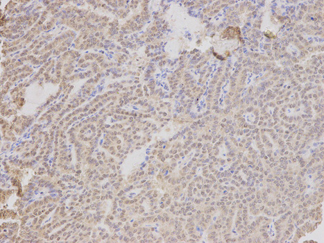 Immunohistochemistry (Formalin/PFA-fixed paraffin-embedded sections) analysis of human thyroid cancer tissue labelling LAP2 with ab185718 at 1/200. Magnification: 200x.