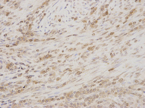 Immunohistochemistry (Formalin/PFA-fixed paraffin-embedded sections) analysis of human endometrial cancer tissue labelling LAP2 with ab185718 at 1/200. Magnification: 400x.