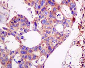 Immunohistochemical analysis of paraffin embedded Human colonic adenocarcinoma tissue using ab154809 showing +ve staining.