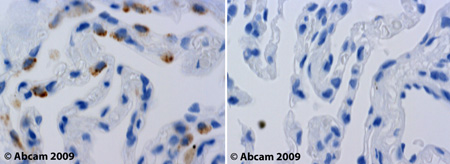 ab30532 staining LDL receptor in human lung parenchyma.Left panel: with primary antibody at 1 ug/ml. Right panel: isotype control.Sections were stained using an automated system (DAKO Autostainer Plus), at room temperature: sections were rehydrated and antigen retrieved with the Dako 3 in 1 AR buffers citrate pH6.1. Slides were peroxidase blocked in 3% H2O2 in methanol for 10 mins. They were then blocked with Dako Protein block for 10 minutes (containing casein 0.25% in PBS) then incubated with primary antibody for 20 min and detected with Dako envision flex amplification kit for 30 minutes. Colorimetric detection was completed with Diaminobenzidine for 5 minutes. Slides were counterstained with Haematoxylin and coverslipped under DePeX. Please note that for manual staining we recommend to optimize the primary antibody concentration and incubation time (overnight incubation), and amplification may be required.