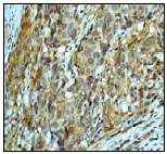 Ab53293 (1:50) staining human LEF1 in human colon adenocarcinoma tissue by immunohistochemistry using paraffin embedded tissue.