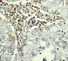 Immunohistochemical analysis of paraffin-embedded human lung carcinoma using ab32129 at 1/50 - 1/100Immunohistochemical analysis of paraffin-embedded human lung carcinoma using ab32129 at 1/50 - 1/100