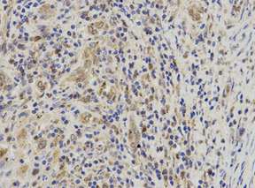 Immunohistochemical analysis of paraffin-embedded Human liver cancer tissue labeling Leukotriene A4 hydrolase using ab196607 at 1/100 dilution.