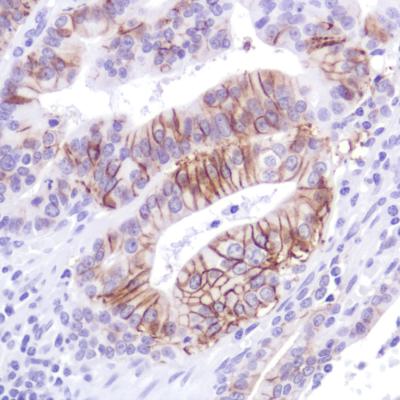 Immunohistochemical analysis of Human stomach adenocarcinoma tissue labeling LI Cadherin using ab183318 at a 1/100 dilution