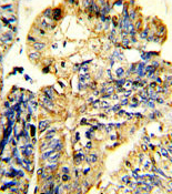 Immunohistochemical staining of LIF in Human colon carcinoma tissue sections (IHC-P - paraformaldehyde-fixed, paraffin-embedded sections) with ab135629 at a dilution of 1/25. Tissue was fixed with formaldehyde and blocked with 3% BSA for 0.5 hours at 38°C. Antigen retrieval was heat mediation with a citrate buffer (pH6). Samples were incubated with primary antibody (1/25) for 1 hour at 37°C. A HRP-conjugated goat anti-rabbit polyclonal (ready to use) was used as the secondary antibody.