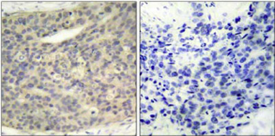 ab38508 at a 1:50 dilution staining LIM Kinase in Human breast carcinoma tissue using Immunohistochemistry, Paraffin Embedded Tissue. Left image : untreated. Right image : treated with phosphopeptide. 