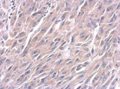 Immunohistochemical analysis of paraffin-embedded Human U87 xenograft labeling Lin28 using ab184213 at a 1/100 dilution.