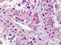 Immunohistochemistry Image of Human Testis (formalin-fixed, paraffin-embedded) stained with Lin28B antibody (ab115698) at 10 µg/ml followed by biotinylated goat anti-rabbit IgG secondary antibody, alkaline phosphatase-streptavidin and chromogen.