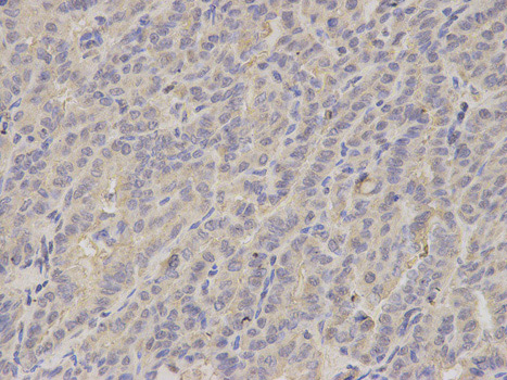 Immunohistochemistry (Formalin/PFA-fixed paraffin-embedded sections) analysis of human thyroid cancer tissue labelling LITAF with ab187533 at 1/200. Magnification: 400x.