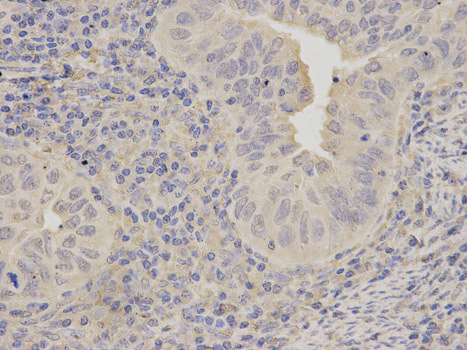 Immunohistochemistry (Formalin/PFA-fixed paraffin-embedded sections) analysis of human endometrial cancer tissue labelling LITAF with ab187533 at 1/200. Magnification: 400x.