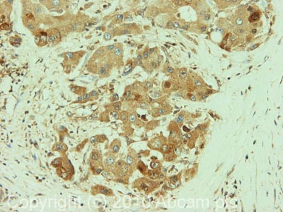 IHC image of Ab85679 staining in Human Breast carcinoma formalin fixed paraffin embedded tissue section, performed on a Leica BondTM system using the standard protocol F. The section was pre-treated using heat mediated antigen retrieval with sodium citrate buffer (pH6, epitope retrieval solution 1) for 20 mins. The section was then incubated with Ab85679, 5µg/ml, for 15 mins at room temperature and detected using an HRP conjugated compact polymer system. DAB was used as the chromogen. The section was then counterstained with haematoxylin and mounted with DPX. For other IHC staining systems (automated and non-automated) customers should optimize variable parameters such as antigen retrieval conditions, primary antibody concentration and antibody incubation times.