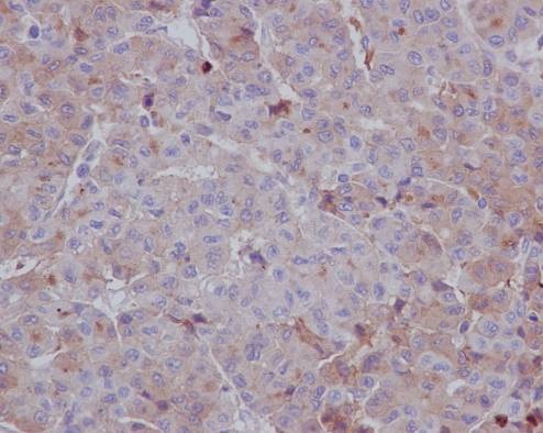 Immunohistochemistry (Formalin/PFA-fixed paraffin-embedded sections) analysis of human hepatocellular carcinoma tissue labelling LRPAP1 with unpurified ab76500 at 1/200. Heat mediated antigen retrieval was performed using Tris/EDTA buffer pH 9. A prediluted HRP-polymer conjugated anti-rabbit IgG was used as the secondary antibody. Counterstained with Hematoxylin.
