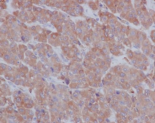 Immunohistochemistry (Formalin/PFA-fixed paraffin-embedded sections) analysis of human hepatocellular carcinoma tissue labelling LRPAP1 with purified ab76500 at 1/100. Heat mediated antigen retrieval was performed using Tris/EDTA buffer pH 9. A prediluted HRP-polymer conjugated anti-rabbit IgG was used as the secondary antibody. Counterstained with Hematoxylin.