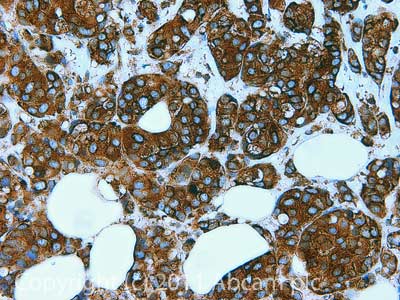 IHC image of ab77598 staining in Human breast cancer formalin fixed paraffin embedded tissue section, performed on a Leica BondTM system using the standard protocol F. The section was pre-treated using heat mediated antigen retrieval with sodium citrate buffer (pH6, epitope retrieval solution 1) for 20 mins. The section was then incubated with ab77598, 5µg/ml, for 15 mins at room temperature and detected using an HRP conjugated compact polymer system. DAB was used as the chromogen. The section was then counterstained with haematoxylin and mounted with DPX.For other IHC staining systems (automated and non-automated) customers should optimize variable parameters such as antigen retrieval conditions, primary antibody concentration and antibody incubation times.