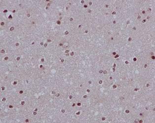 Immunohistochemical analysis of paraffin embedded Human astrocytoma tissue labeling LSM5 with ab184568 at a 1/100 dilution. Counterstained with Hematoxylin.
