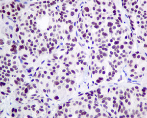 Immunohistochemical analysis of paraffin-embedded Human thyroid gland carcinoma tissue labeling LSM5 with ab151717 at 1/50 dilution.