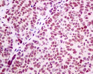 Immunohistochemical analysis of paraffin embedded Human Ovarian carcinoma tissue using ab151717 showing +ve staining.