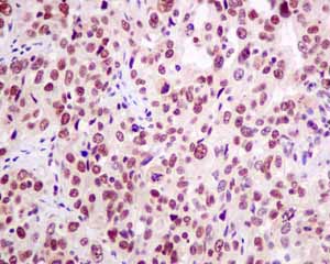 Immunohistochemical analysis of paraffin embedded Human Cervical carcinoma tissue using ab151717 showing +ve staining.