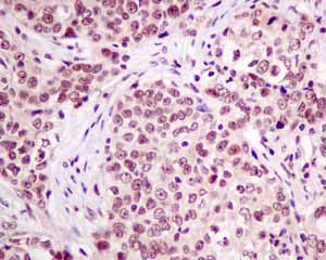 Immunohistochemical analysis of paraffin embedded Human Breast carcinoma tissue using ab151717 showing +ve staining.