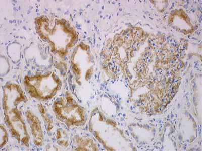 ab2489 staining human renal cell carcinoma by Immunohistochemistry (frozen sections).
