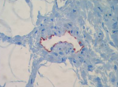 IHC with paraffin-embedded sections of human intestine (border area of a colon carcinoma) using antibody ab36993.