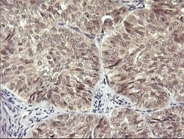 Immunohistochemical analysis of paraffin-embedded Human ovary adenocarcinoma tissue labelling LZIC with ab140965 at 1/150 dilution.