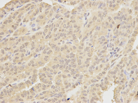 Immunohistochemistry (Formalin/PFA-fixed paraffin-embedded sections) analysis of human thyroid cancer tissue labelling MAD1 with ab175245 at 1/200. Magnification: 400x.