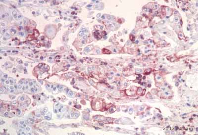 ab115622 staining Mad2L2 in Human lung cancer tissue sections by Immunohistochemistry (IHC-P - paraformaldehyde-fixed, paraffin-embedded sections). Tissue was fixed with the Hope Technique and blocked for 15 minutes at 25°C. Samples were incubated with primary antibody (1/300) for 1 hour at 25°C. An undiluted HRP-conjugated Goat anti-rabbit IgG polyclonal was used as the secondary antibody.See Abreview